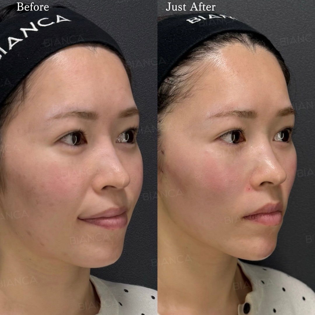 鼻翼基部・あごヒアルロン酸・糸リフト