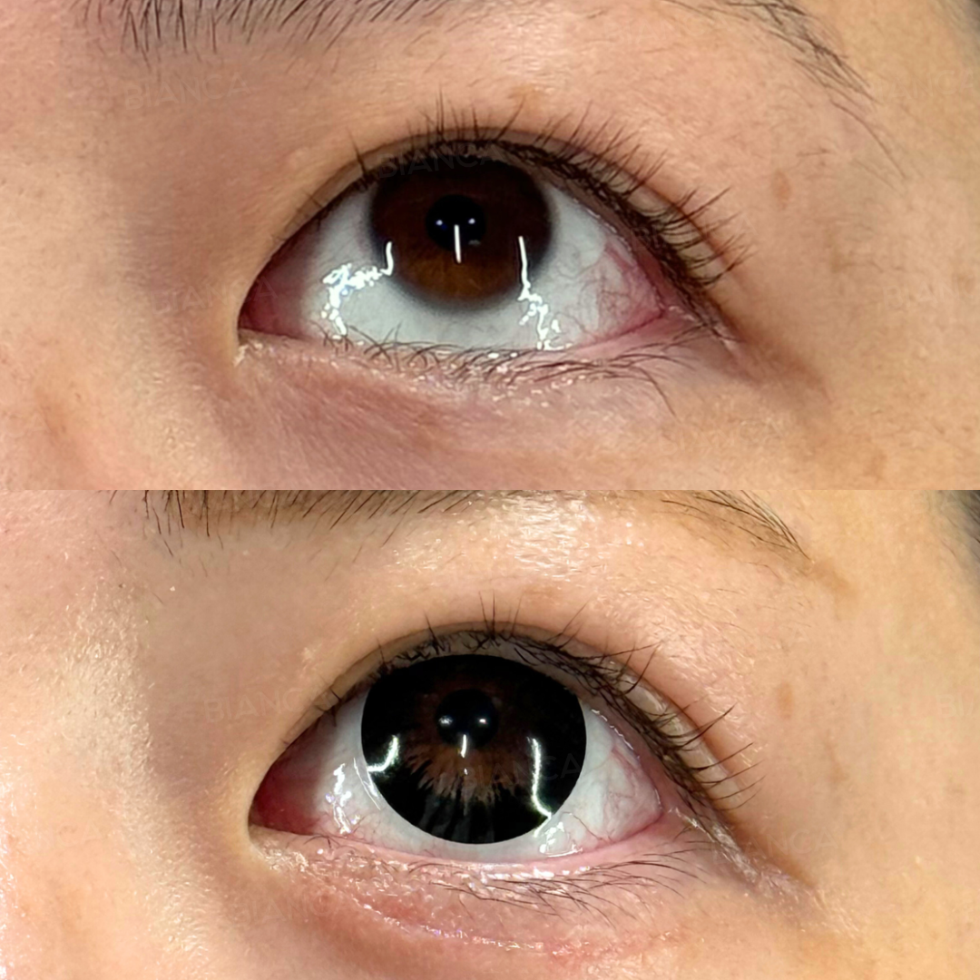 逆さまつげ治療