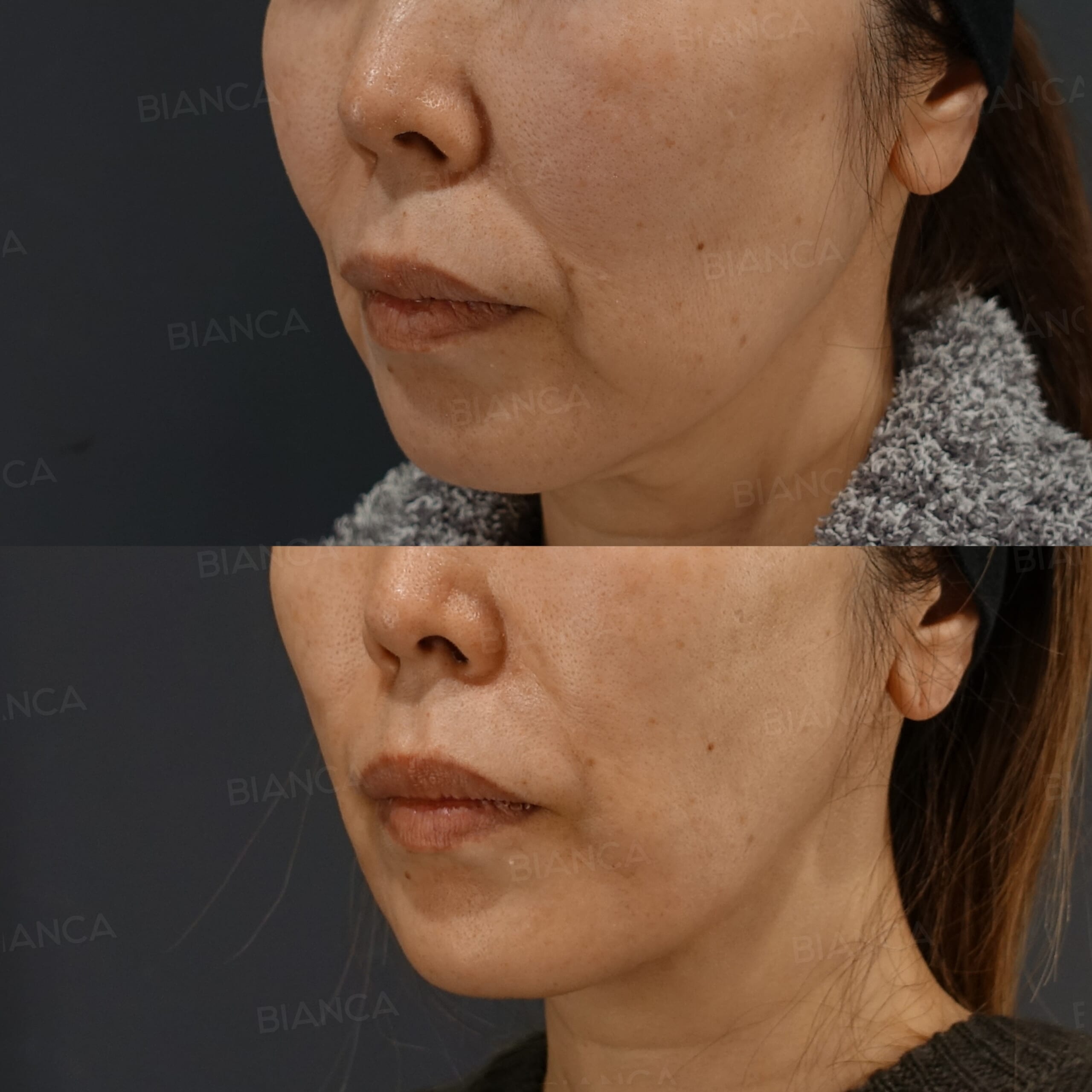 トータルフェイスサクションリフト（メーラー・頬・顎下）・エンブレイスRF・フェイスタイト（頬・顎下）・ モフィウス8 （頬＋顎下）・ BIANCA LIFT