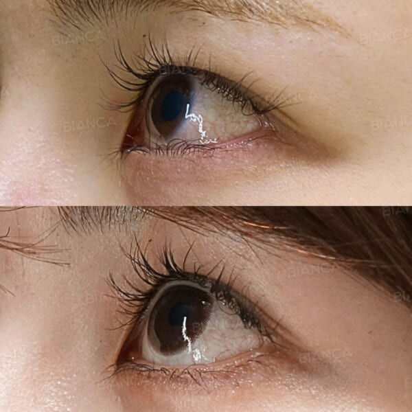 逆さまつげ治療｜銀座・表参道にあるBIANCA CLINIC ビアンカクリニック｜美容外科・美容皮膚科・再生医療・美容婦人科・美容内科・医療アートメイク