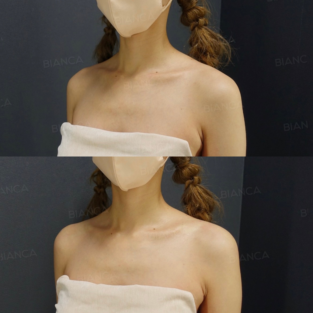 ヒアルロン酸注射（肩）