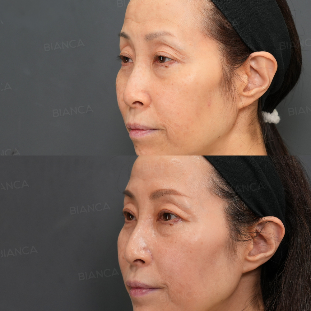 眼瞼下垂 切開法