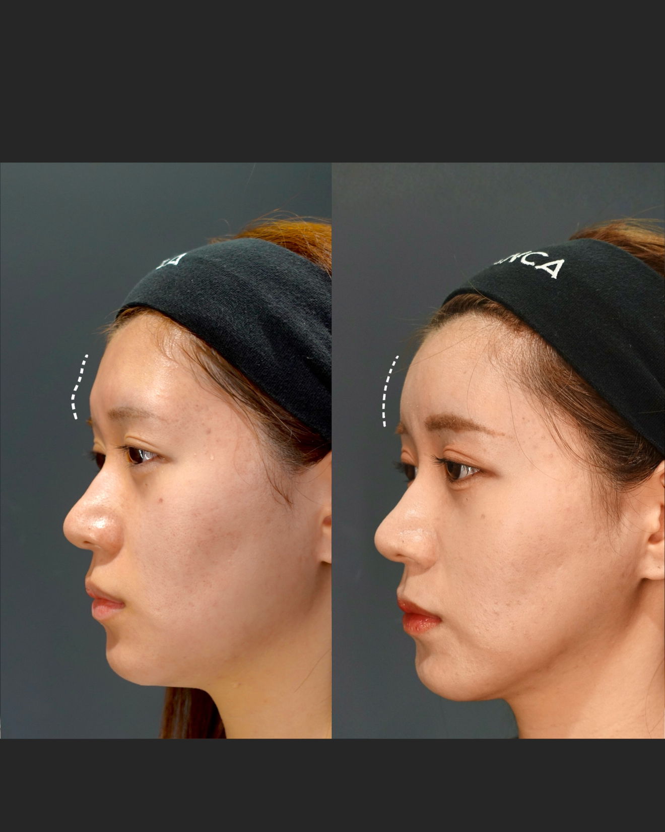 脂肪注入 ・脂肪吸引 ・糸リフト