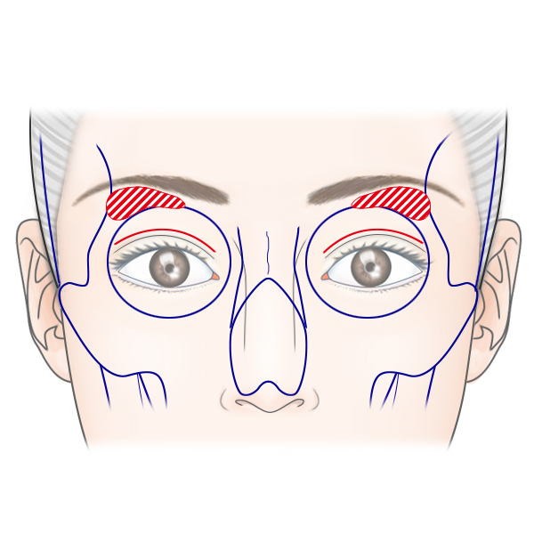眉骨削りとは