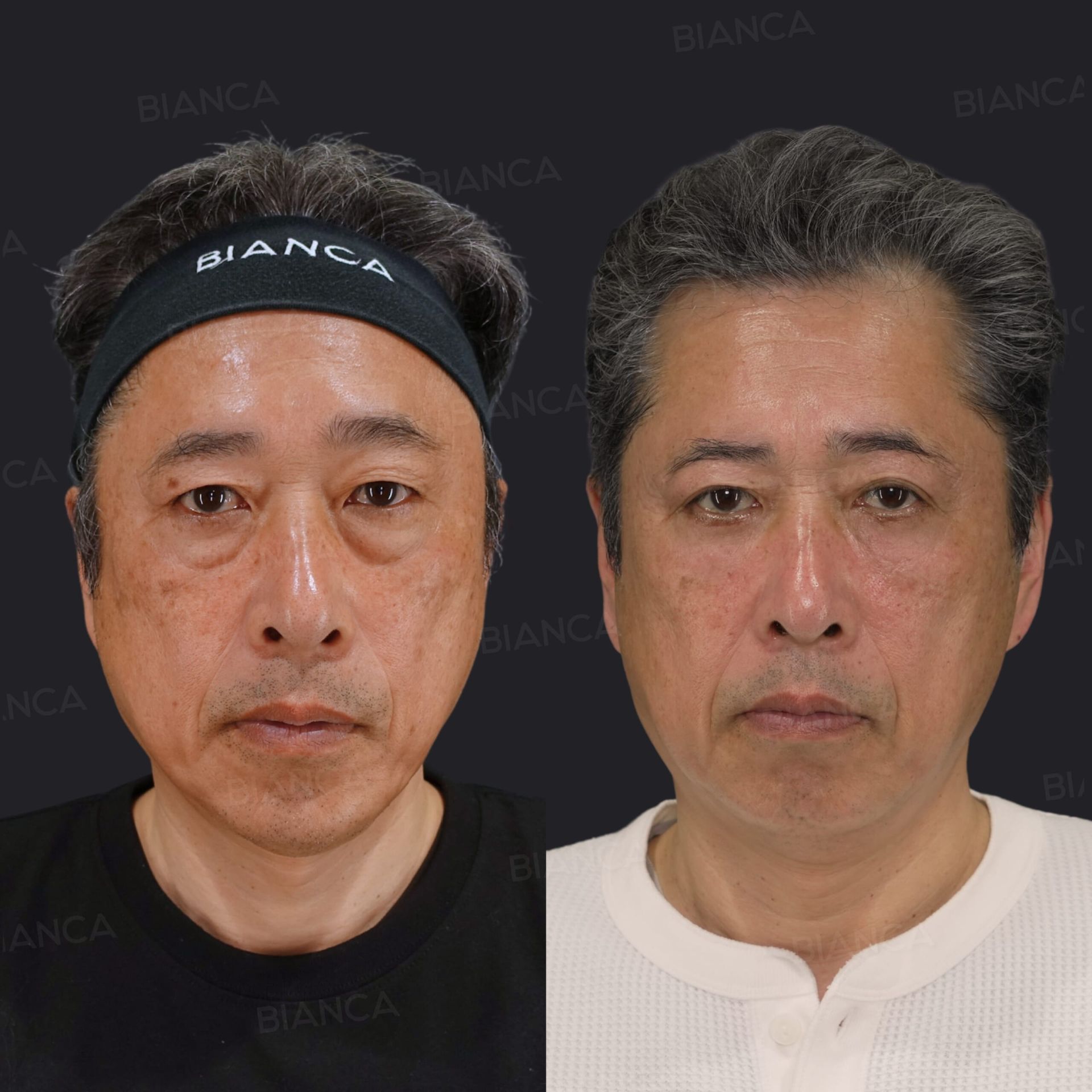 眉下切開、ピコスポット(シミ取り)、ハムラ法