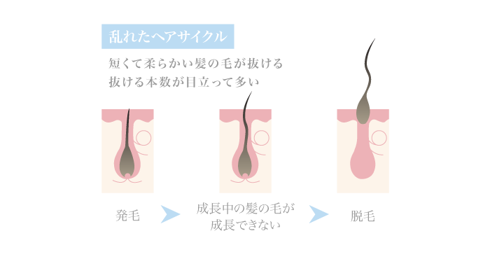 女性男性型脱毛症（FAGA）の特徴とメカニズム