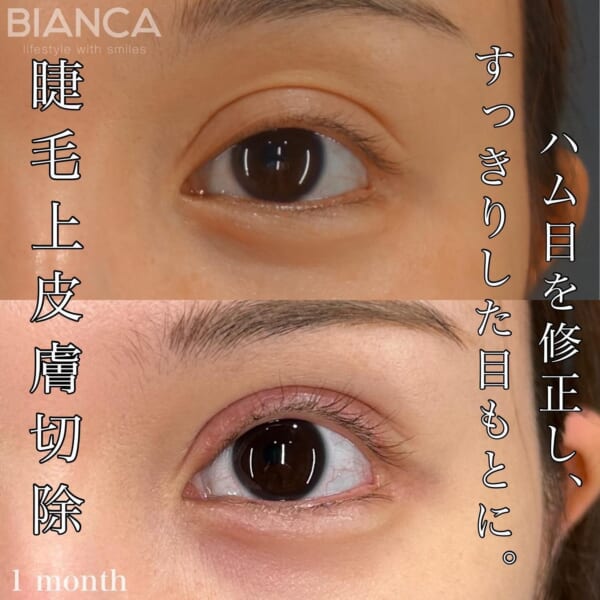 ハム目 銀座・表参道にあるBIANCA CLINIC ビアンカクリニック｜美容外科・美容皮膚科・再生医療・美容婦人科・美容内科