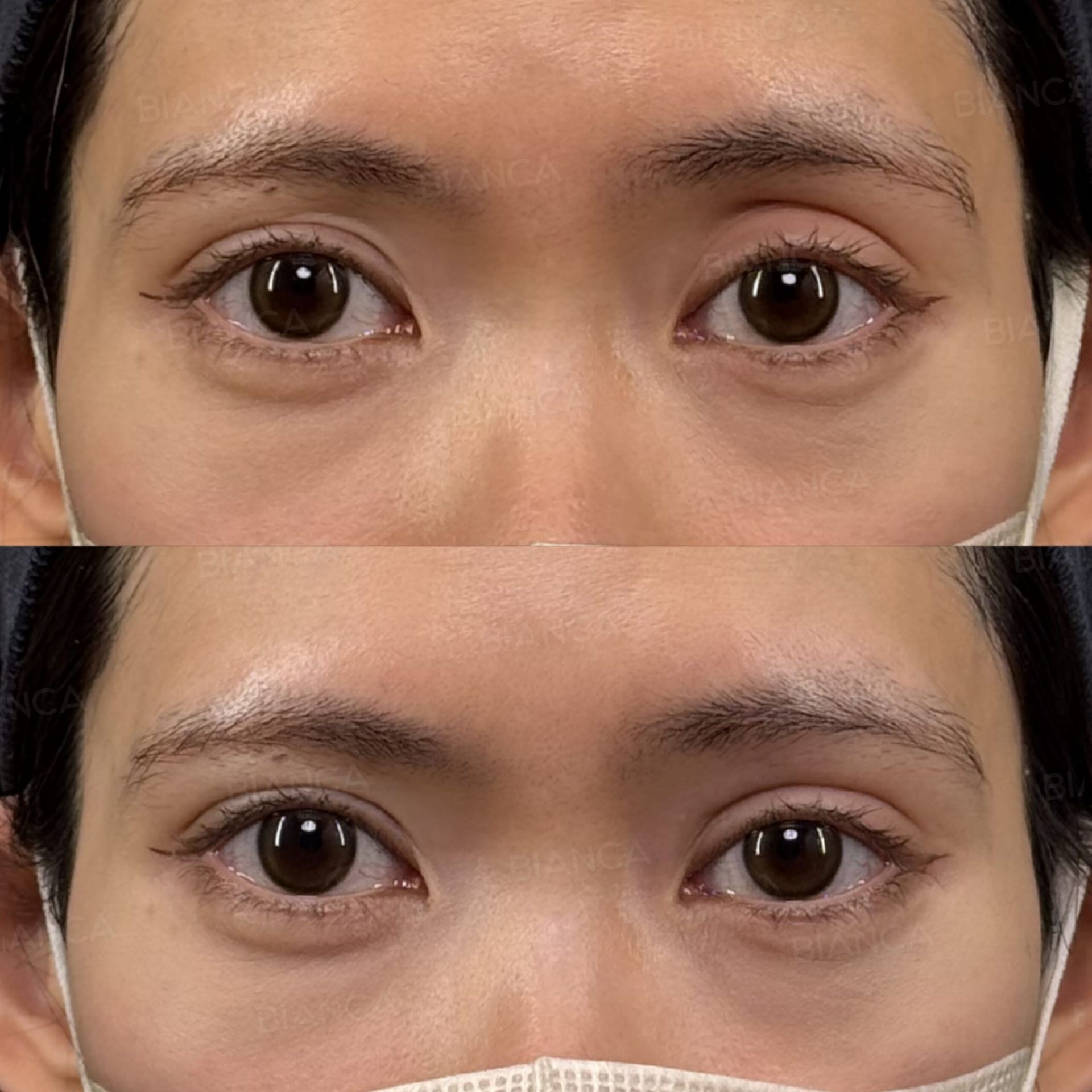 ヒアルロン酸注射(目の上)