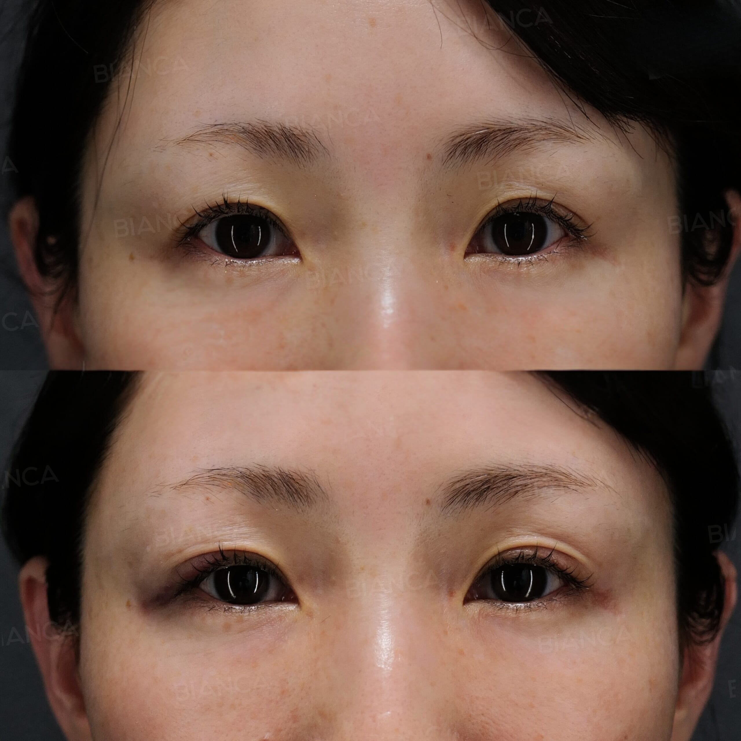 ヒアルロン酸注射(上瞼)