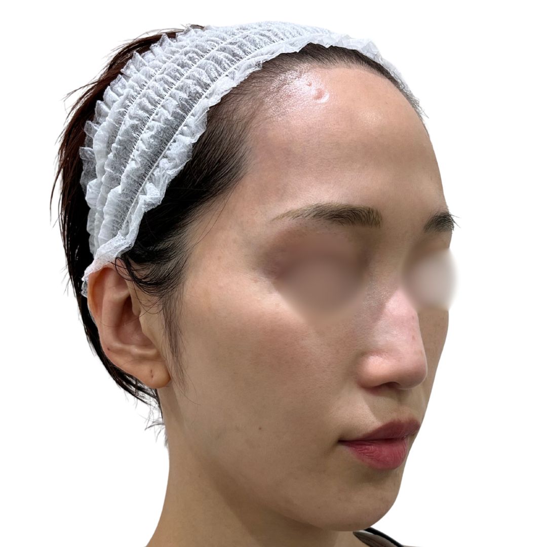 アドバテックスレーザー