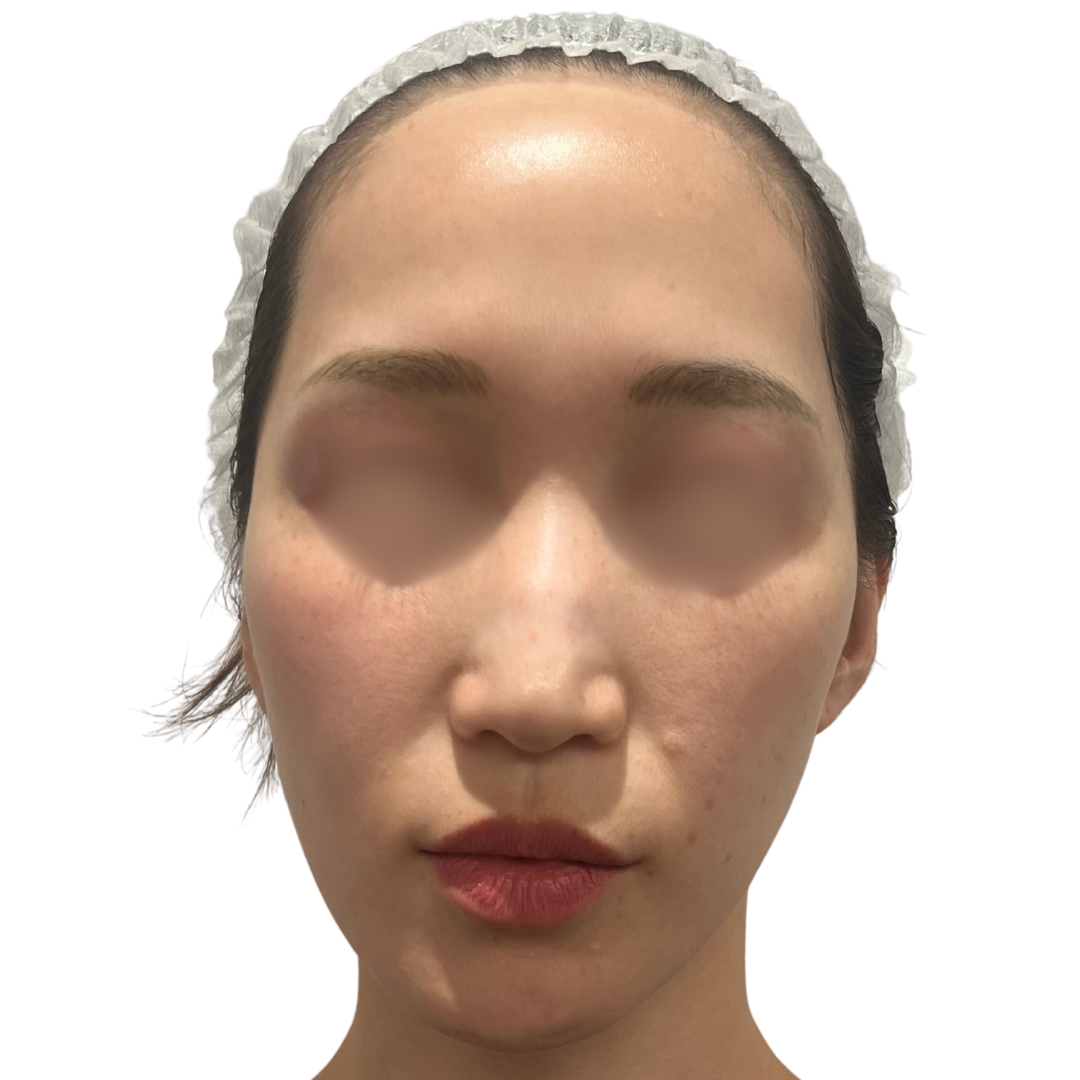 アルマ プライムX（Alma PrimeX）