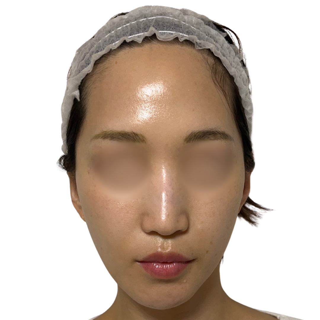 アルマ プライムX（Alma PrimeX）