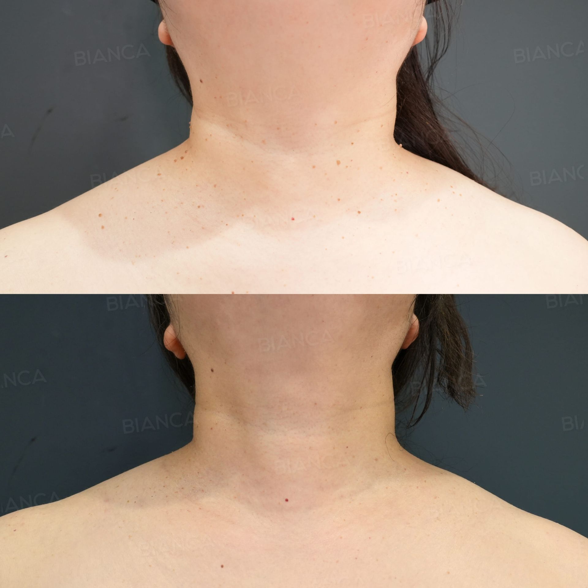 CO2レーザー(イボ取り)