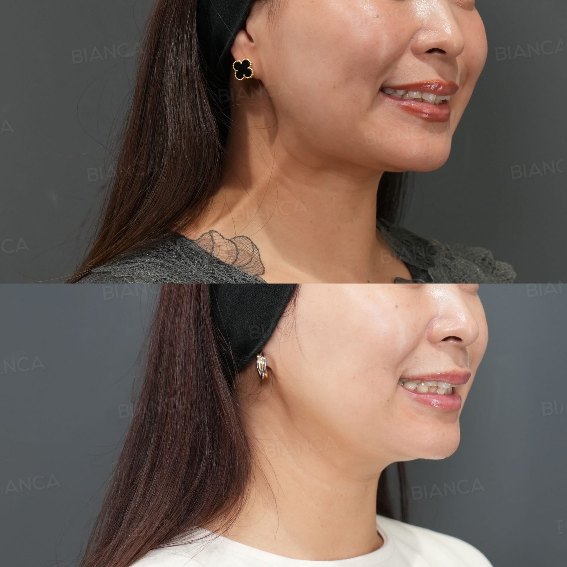 ボトックス注射(広頚筋)