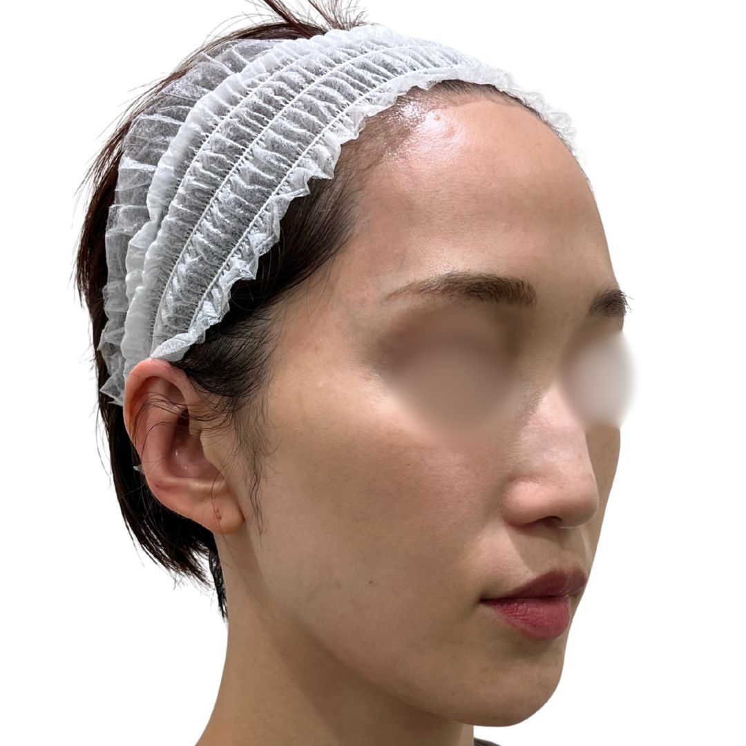 アドバテックスレーザー