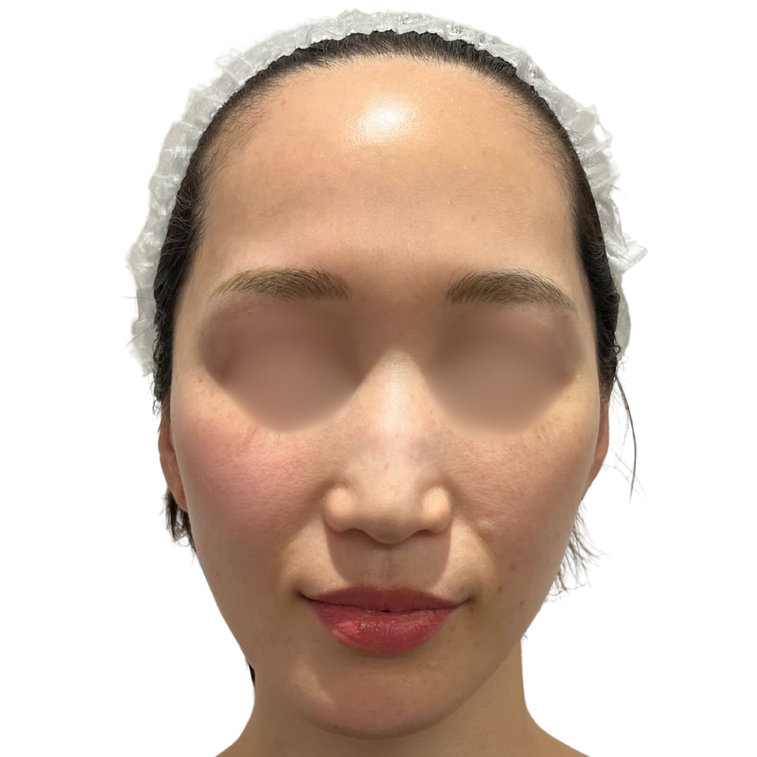 アルマ プライムX（Alma PrimeX）