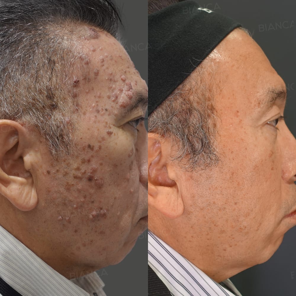 CO2レーザー(イボ取り)