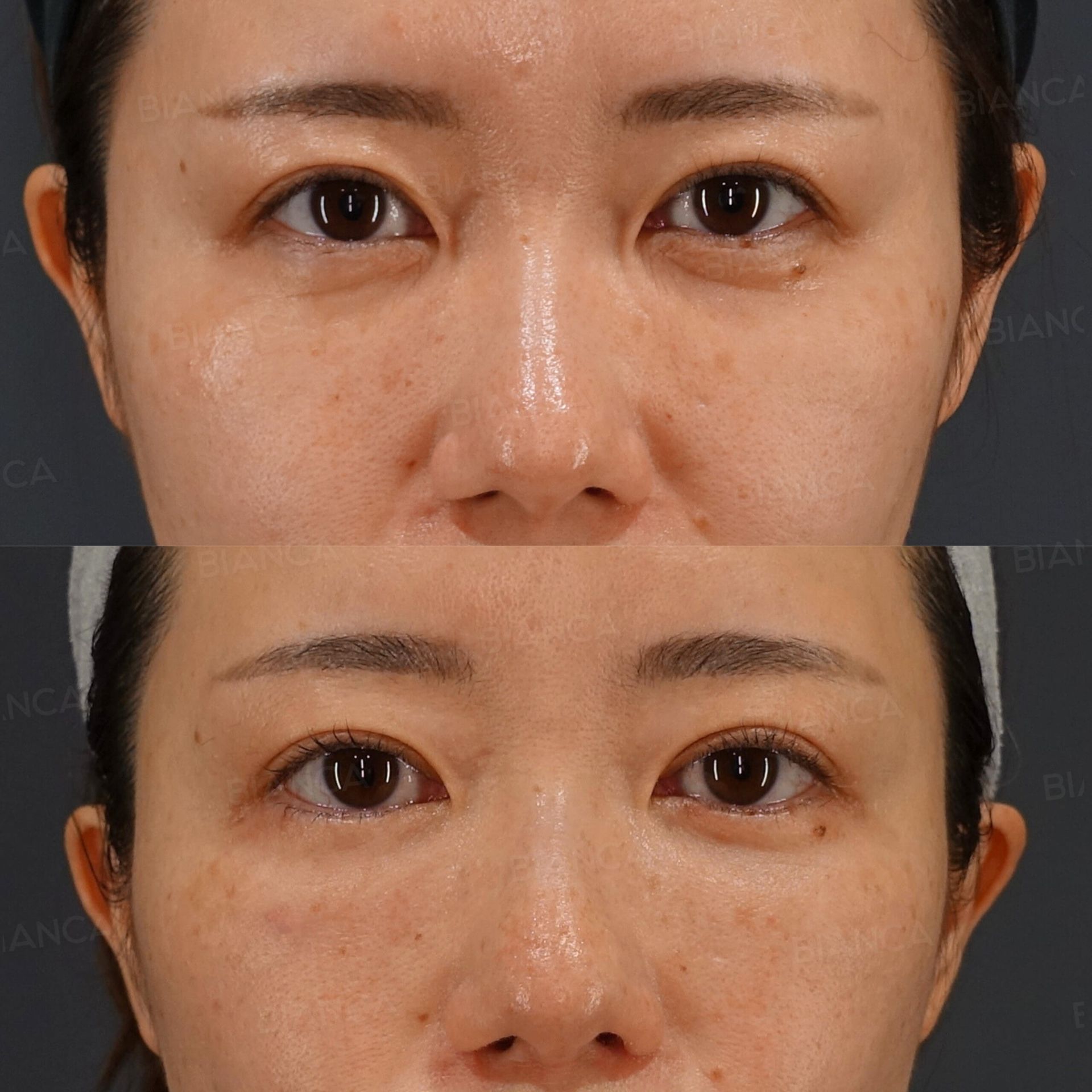 ミッドフェイスリフト