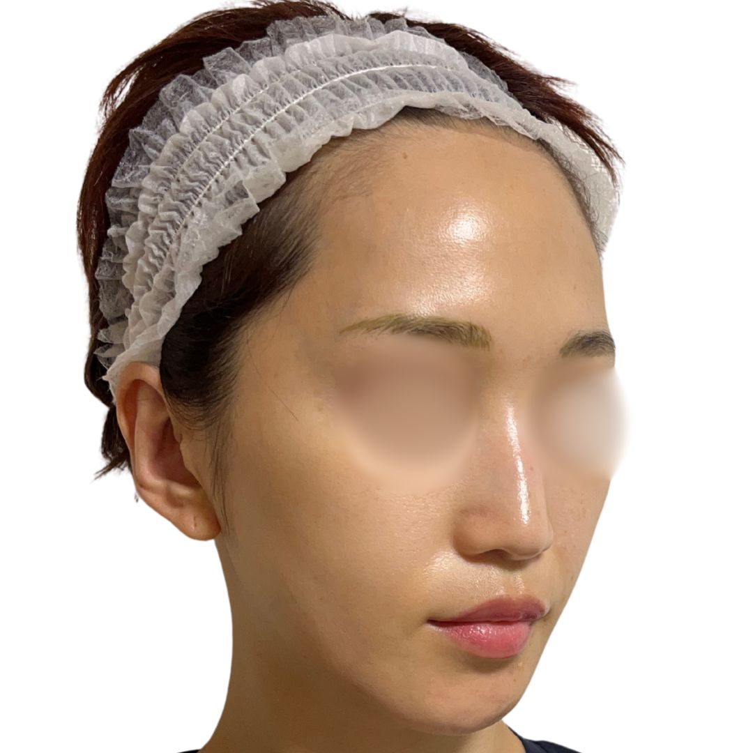 アドバテックスレーザー