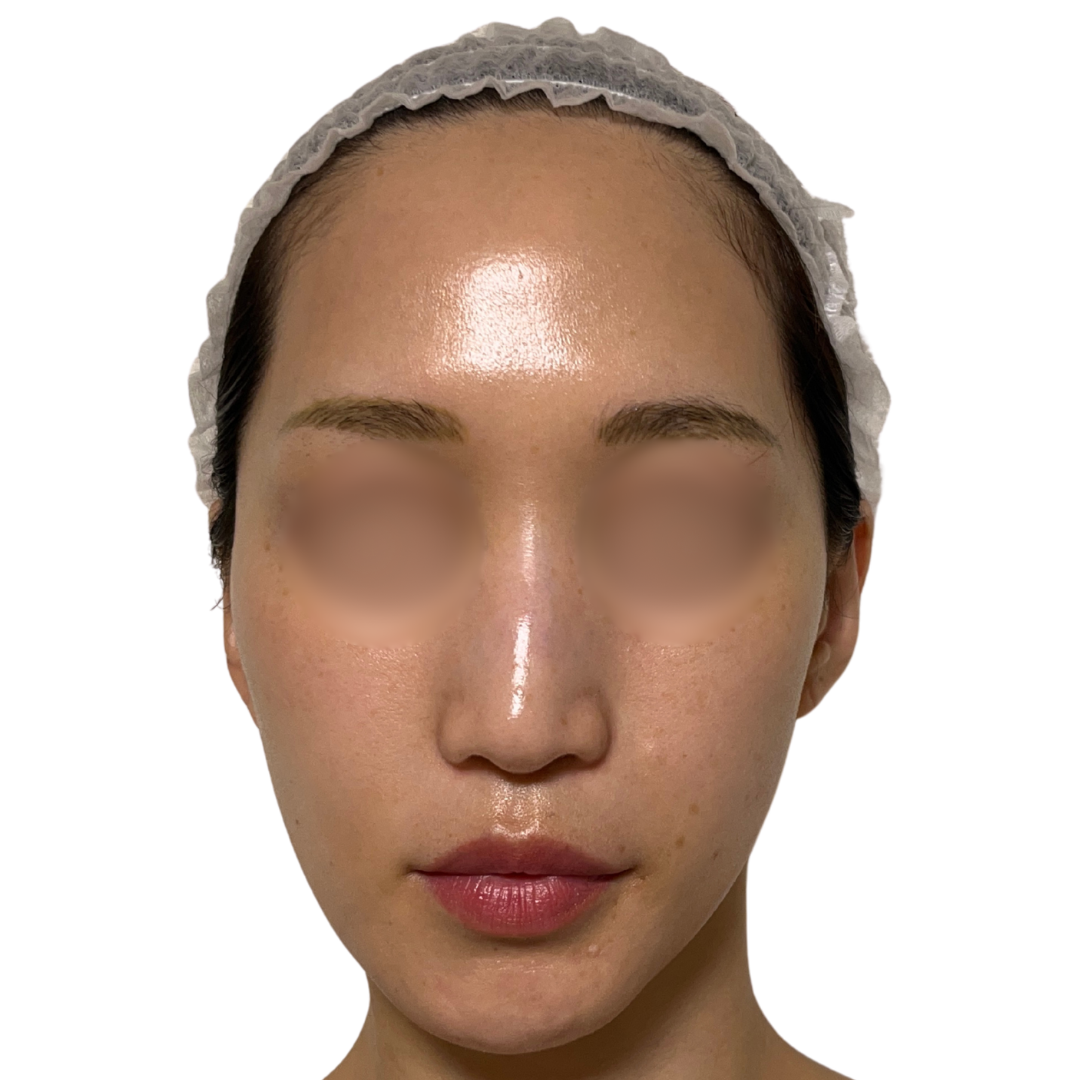 アルマ プライムX（Alma PrimeX）