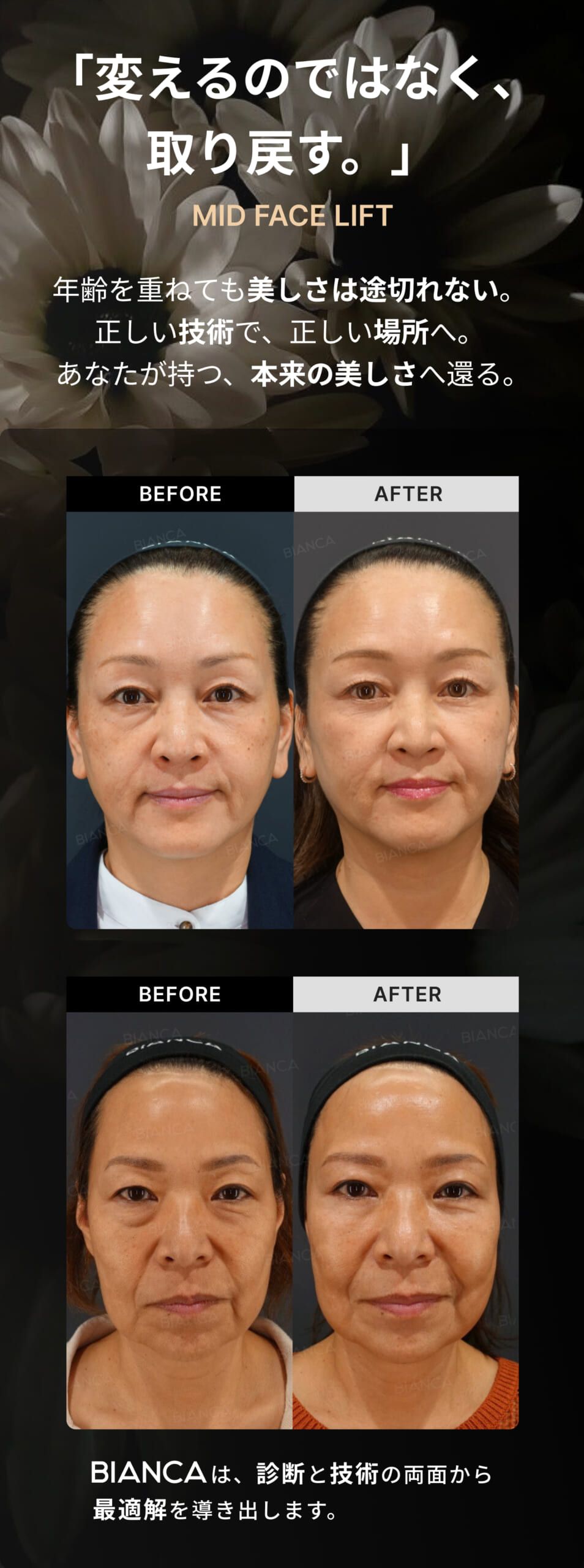 ミッドフェイスリフト 銀座・表参道にあるBIANCA CLINIC ビアンカ