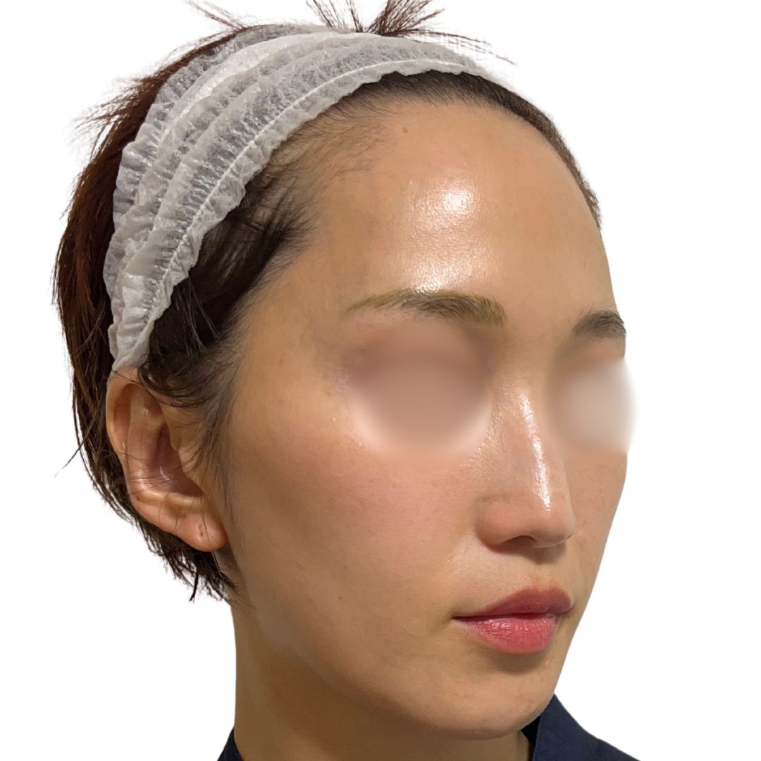 アドバテックスレーザー