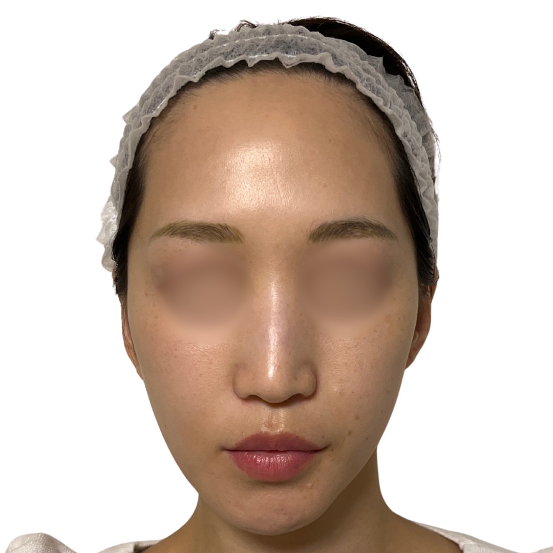 アルマ プライムX（Alma PrimeX）