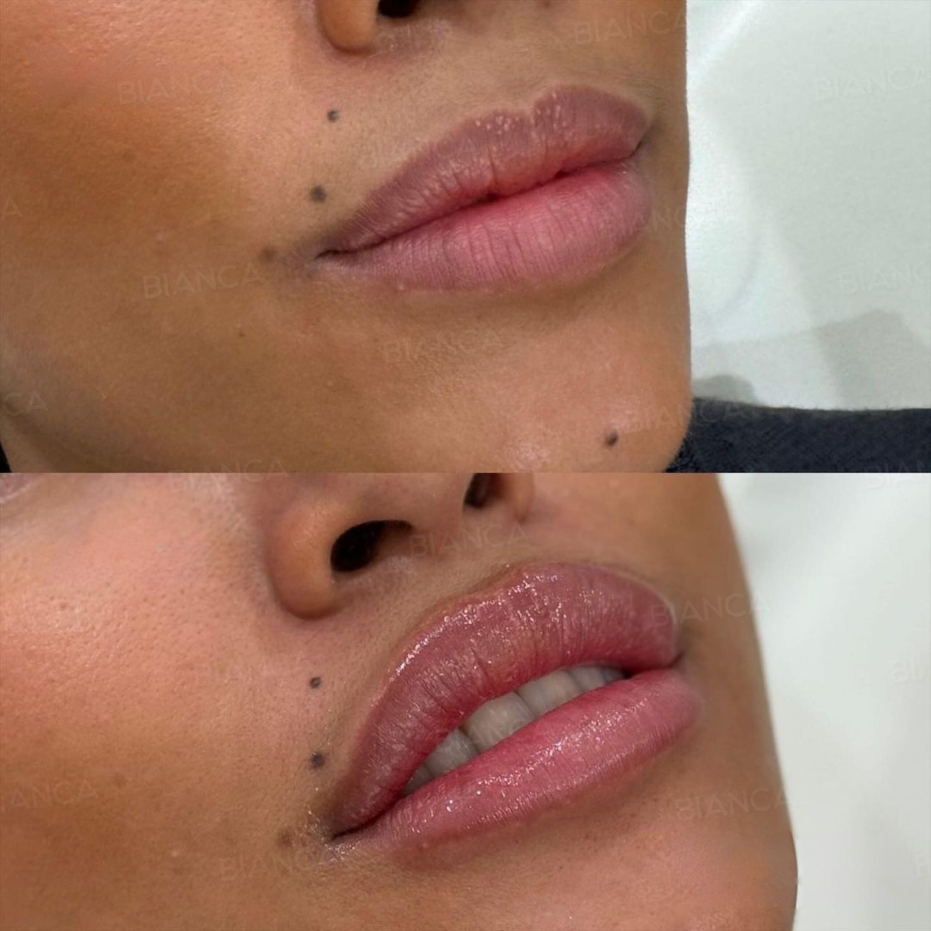 ヒアルロン酸注射(唇)