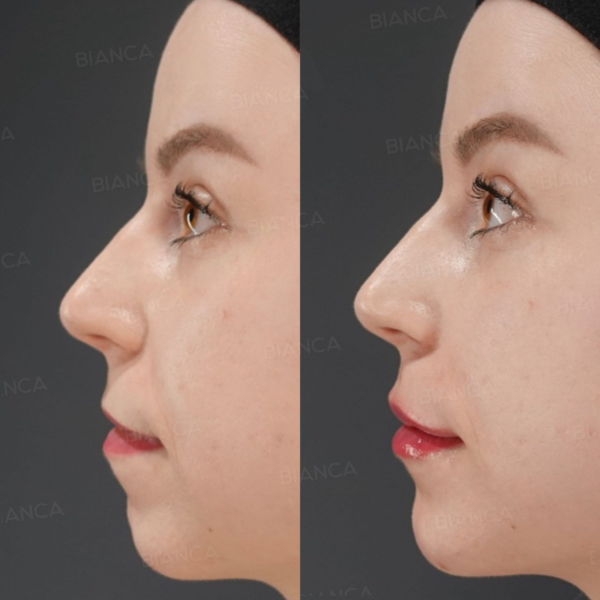 122ヒアルロン酸注射(唇) 