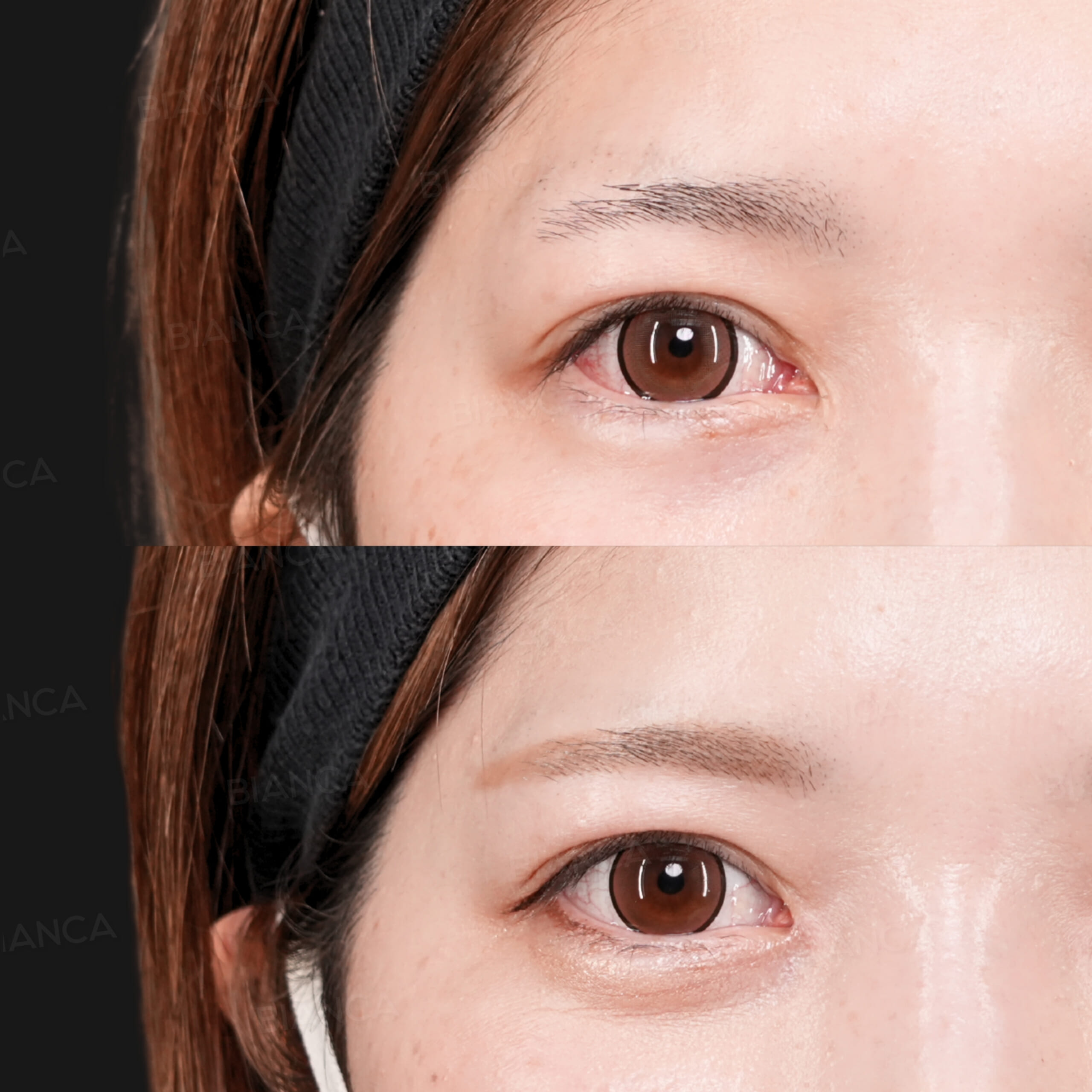 蒙古襞形成（目頭切開修正）