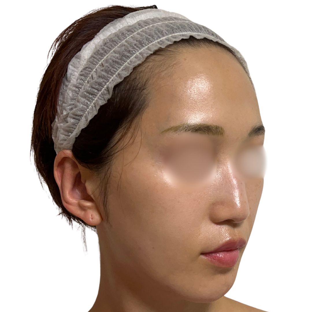 アドバテックスレーザー