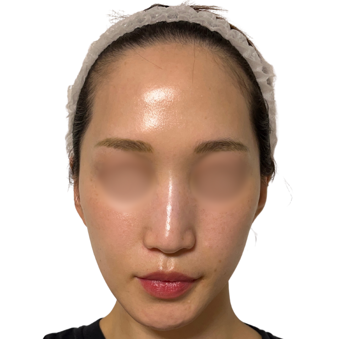 アルマ プライムX（Alma PrimeX）