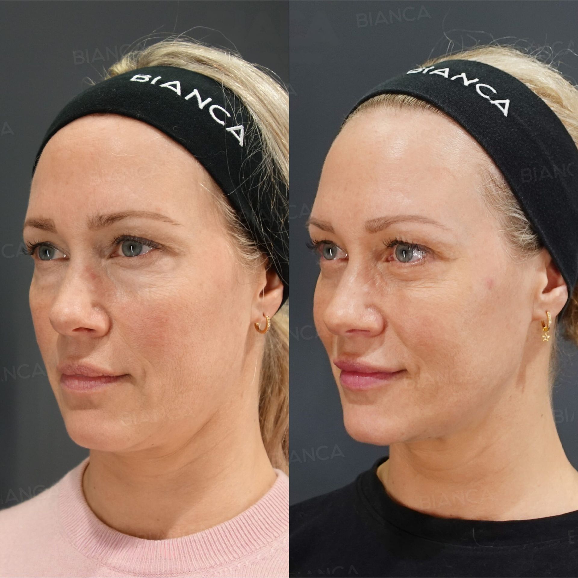 表ハムラ、ヒアルロン酸注射(額 )