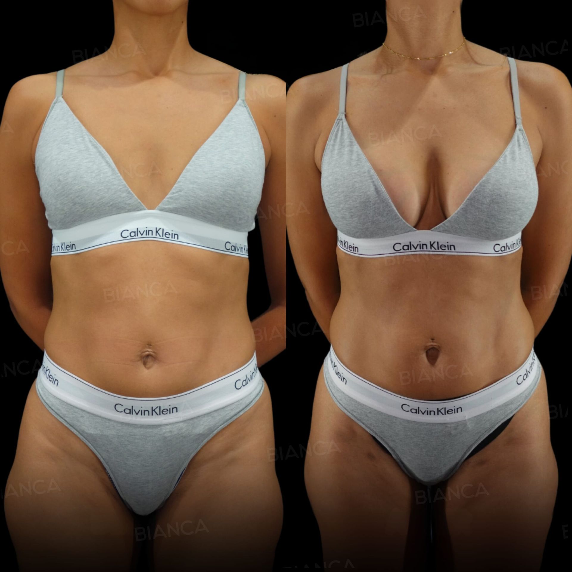 ハイブリッド豊胸