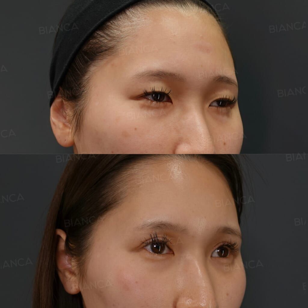 眼瞼下垂切開法｜銀座・表参道にあるBIANCA CLINIC ビアンカクリニック