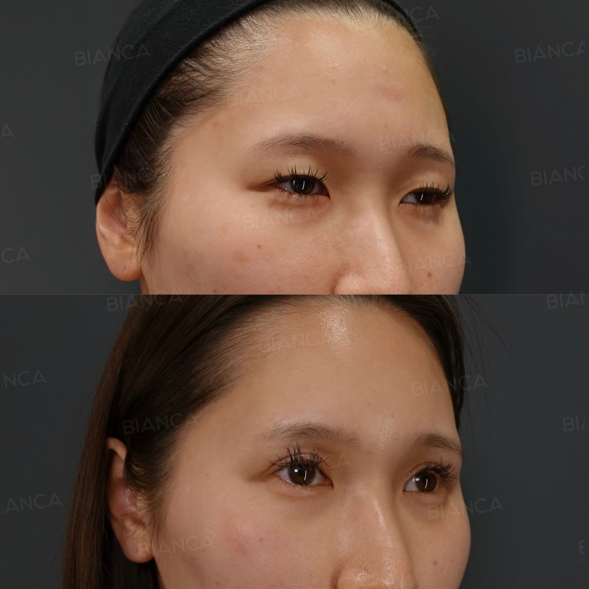 眼瞼下垂切開法