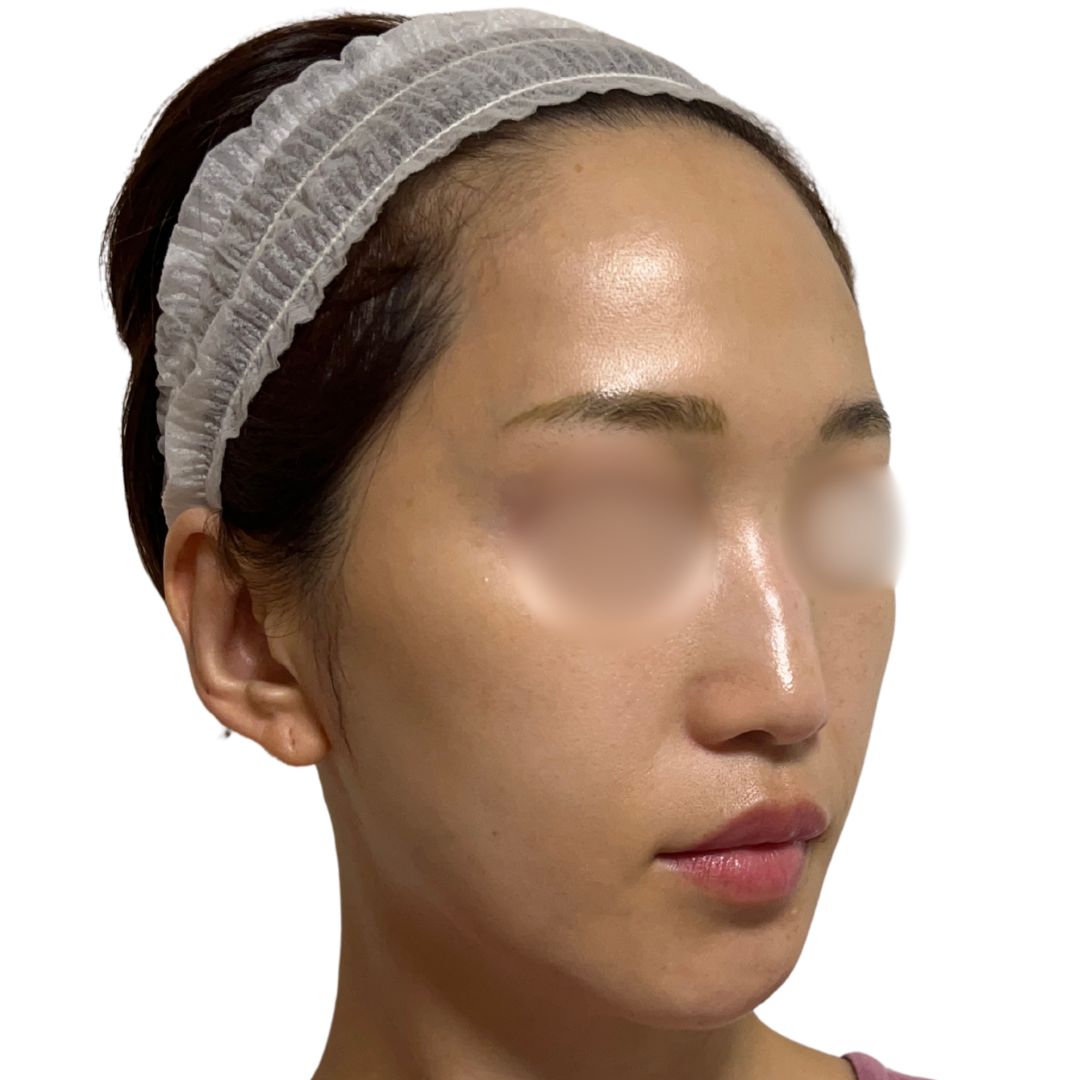 アドバテックスレーザー