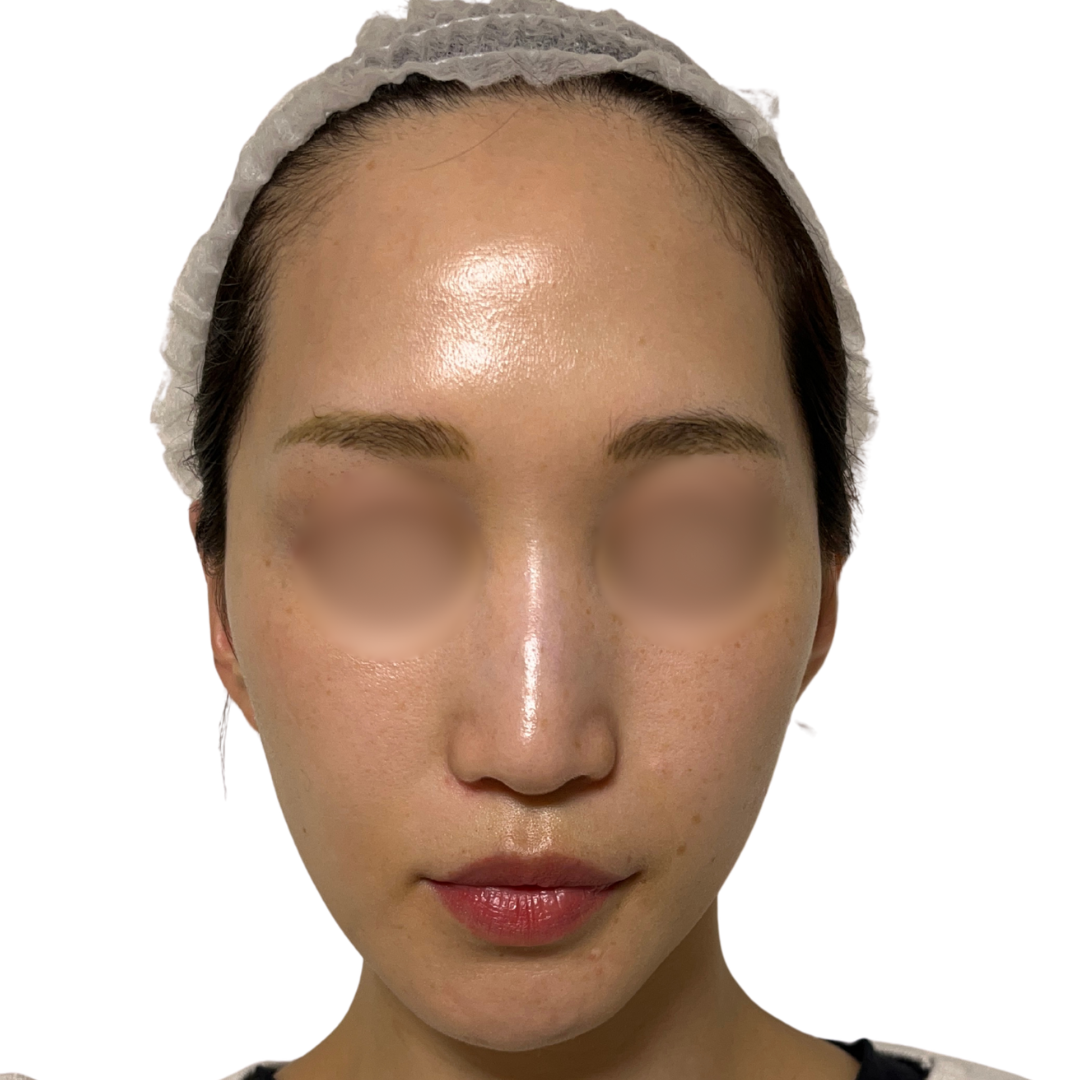 アルマ プライムX（Alma PrimeX）