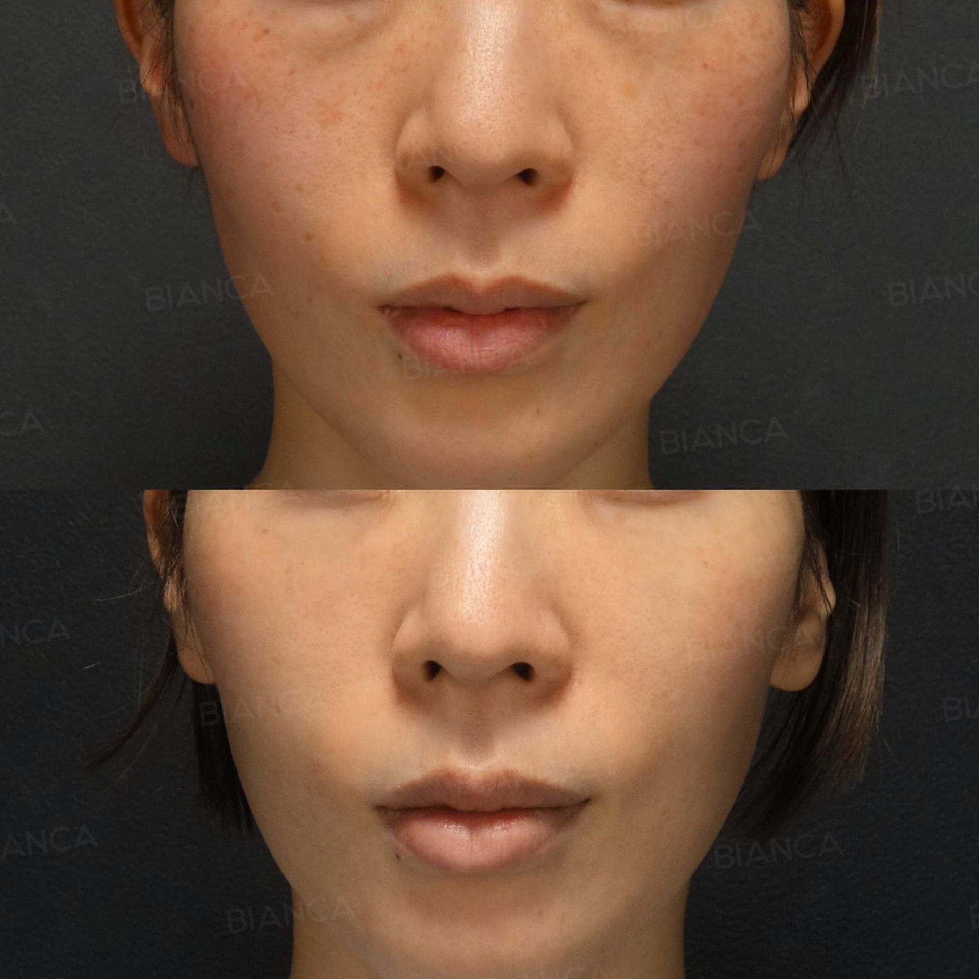 ピコスポット、ピコトーニング