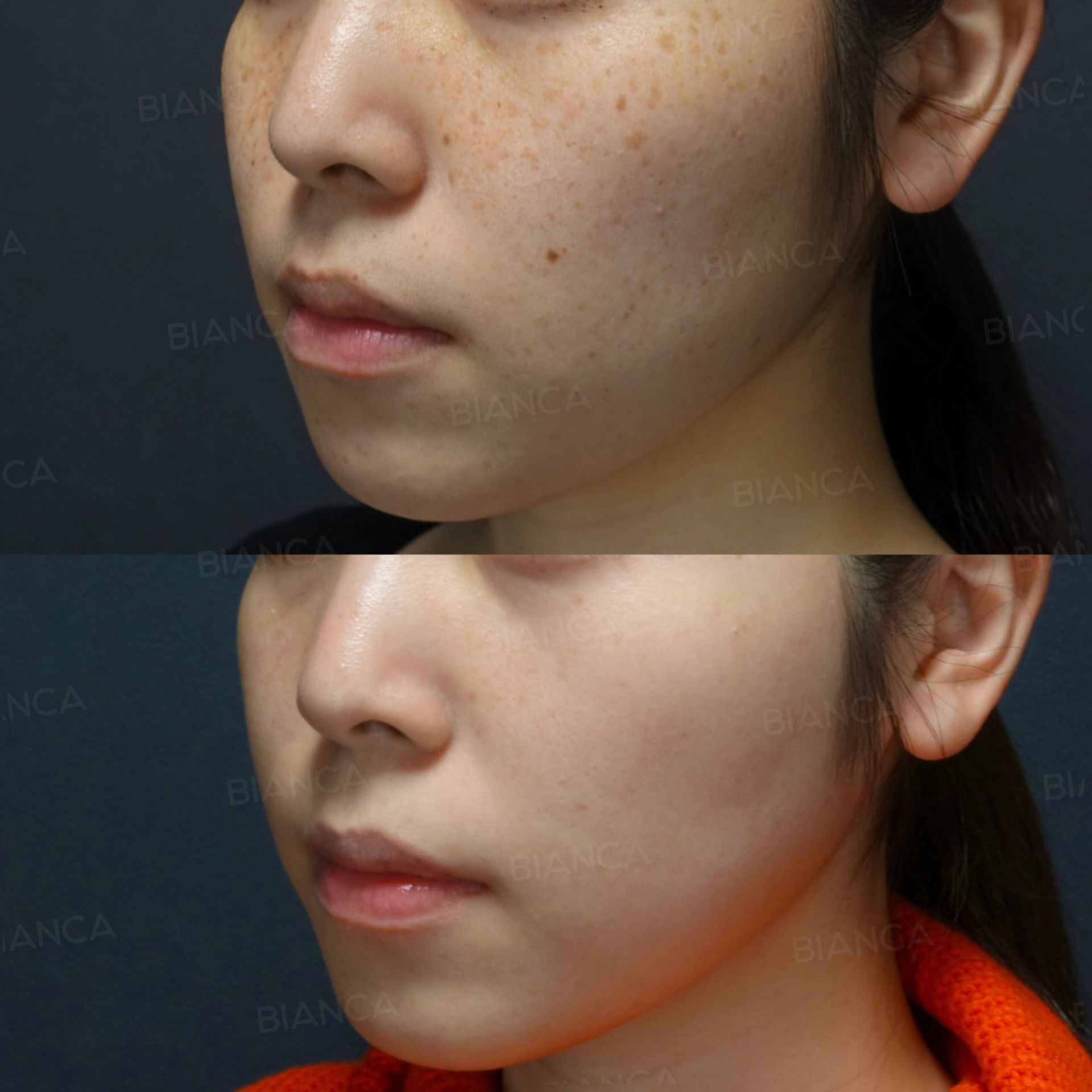 ピコスポット、ピコトーニング