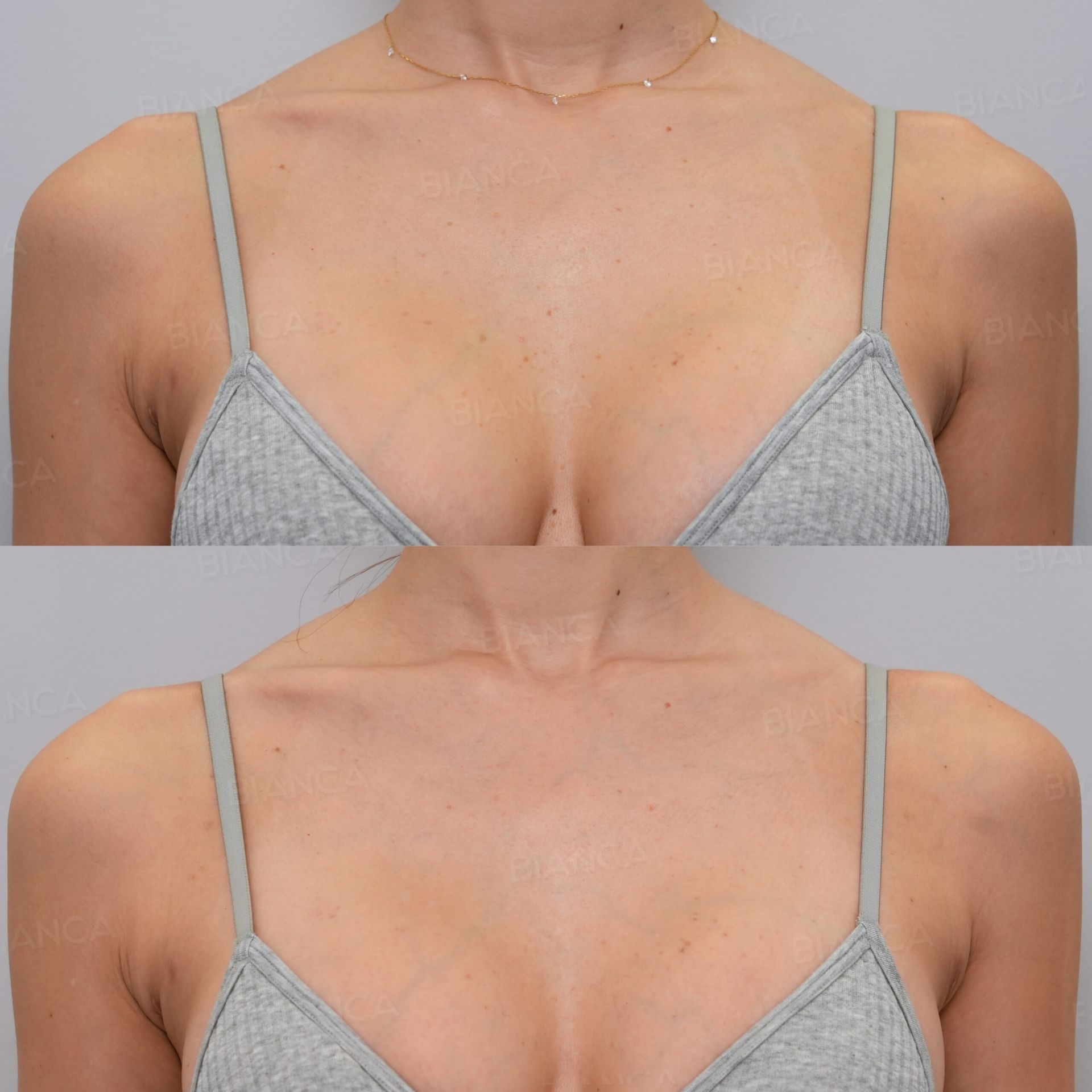 ピコトーニング(デコルテ)