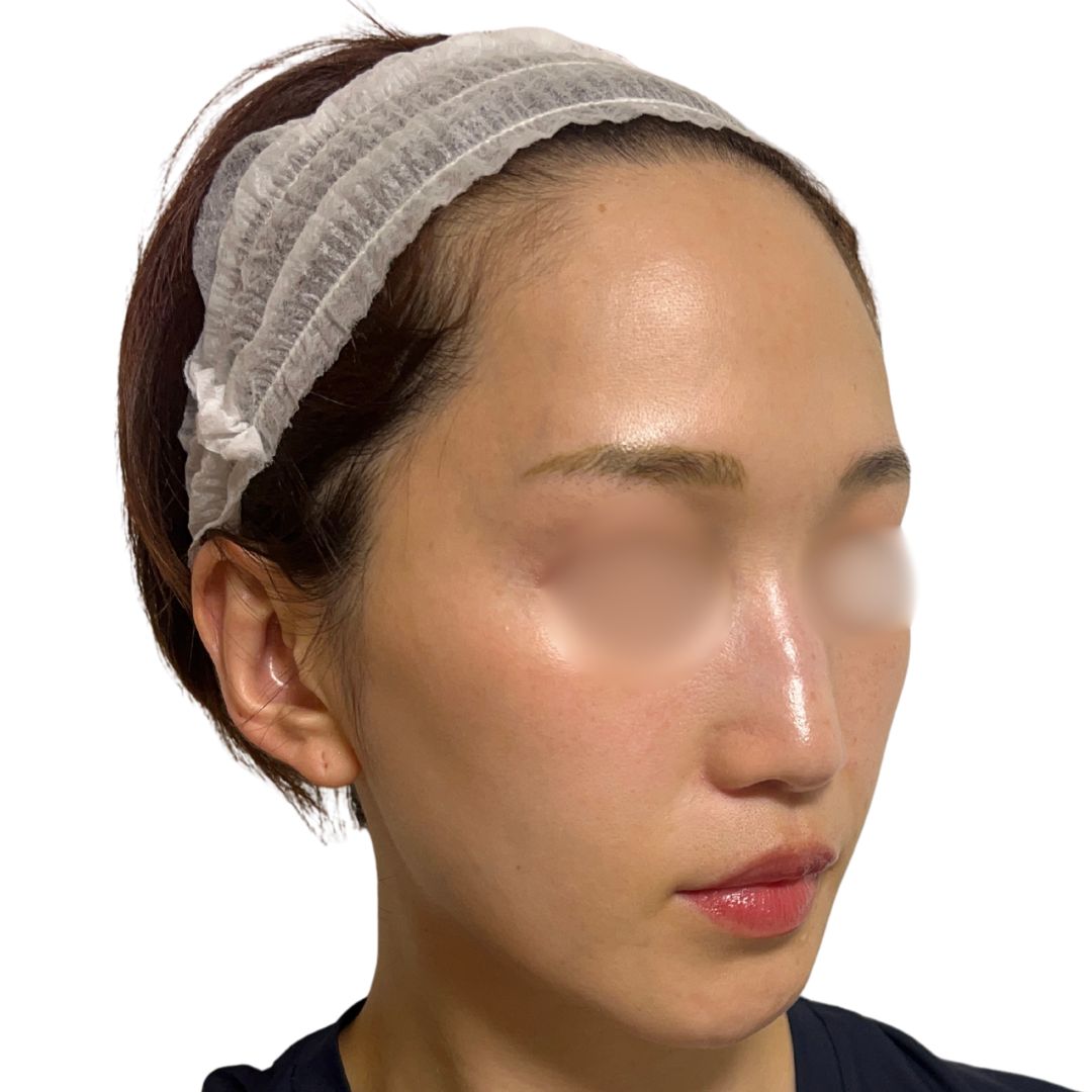 アドバテックスレーザー