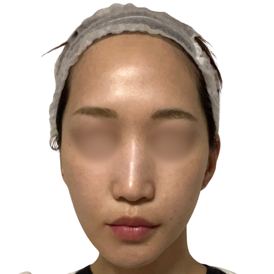 アルマ プライムX（Alma PrimeX）