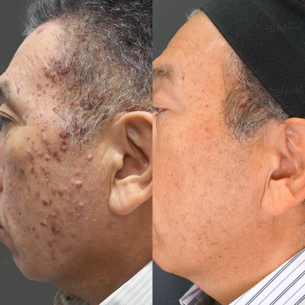 CO2レーザー(イボ取り)