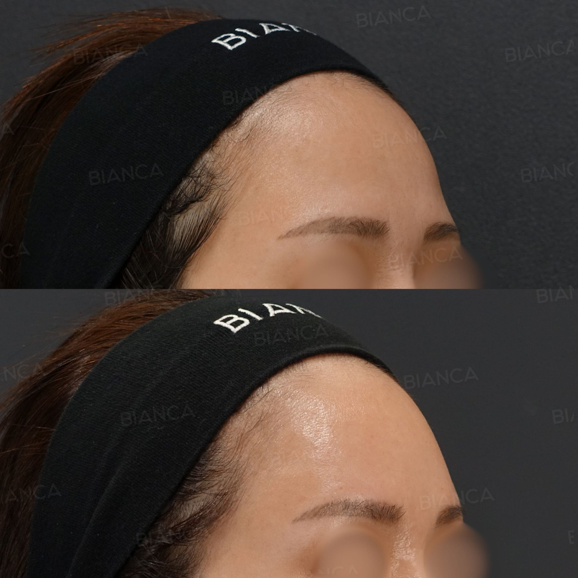 ヒアルロン酸注射(額)