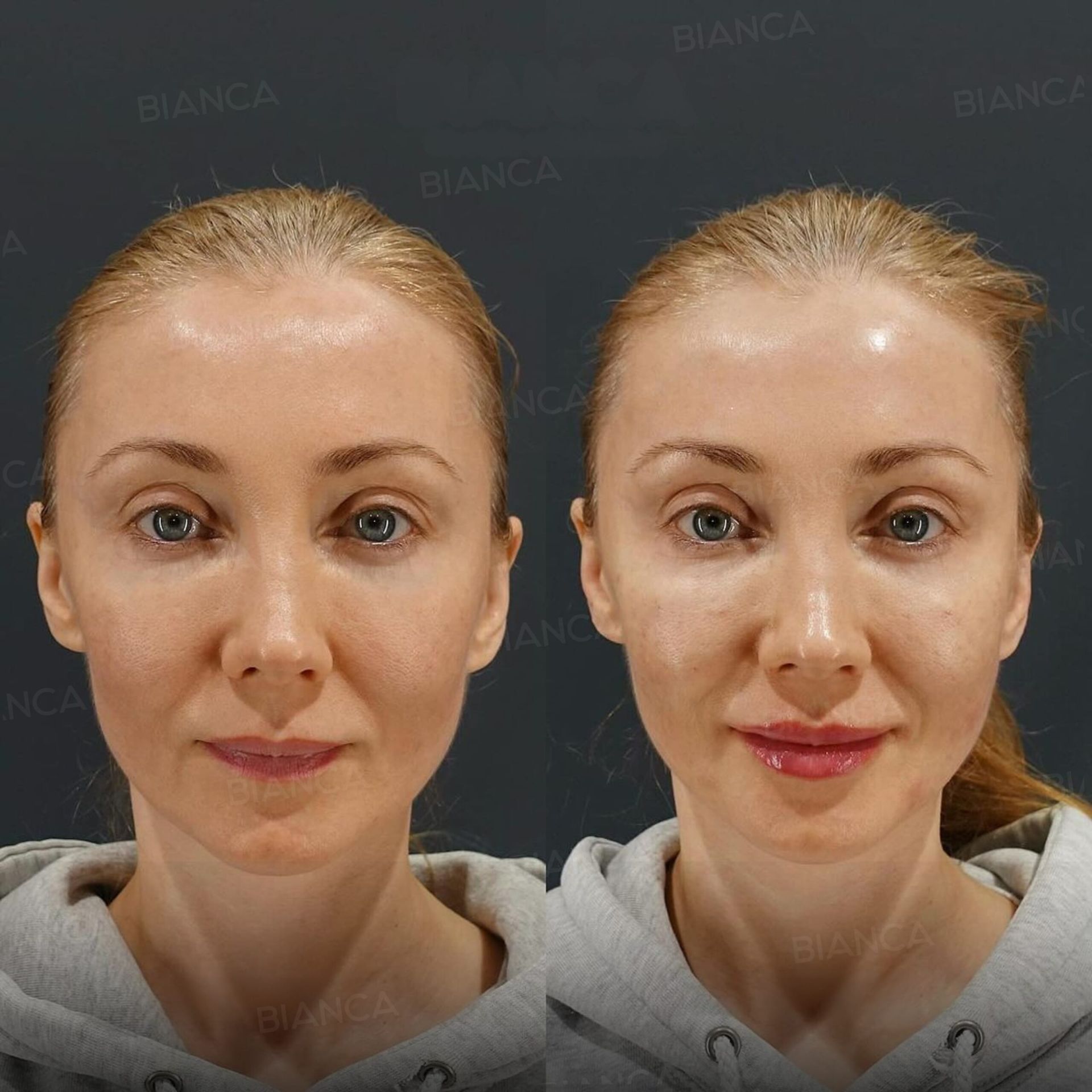 ヒアルロン酸注射(唇)