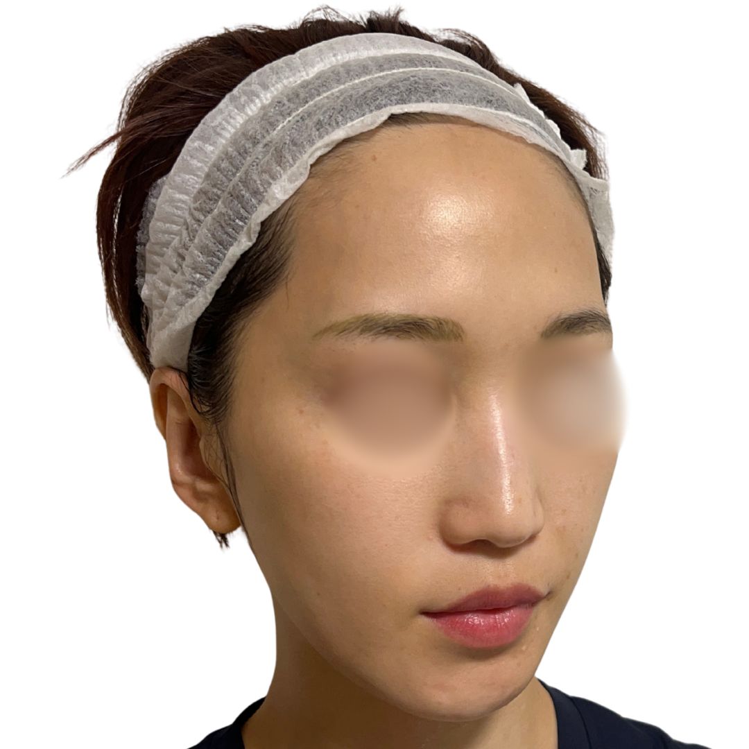 アドバテックスレーザー