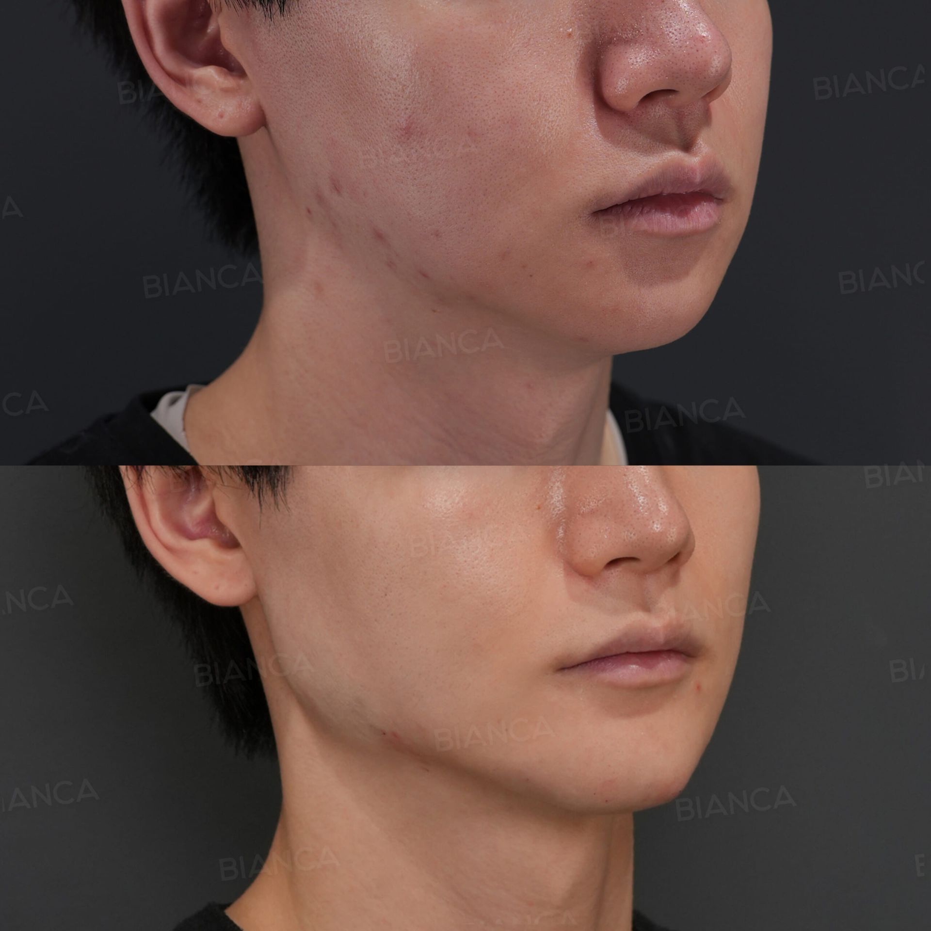 ヒアルロン酸注射(エラ、顎)