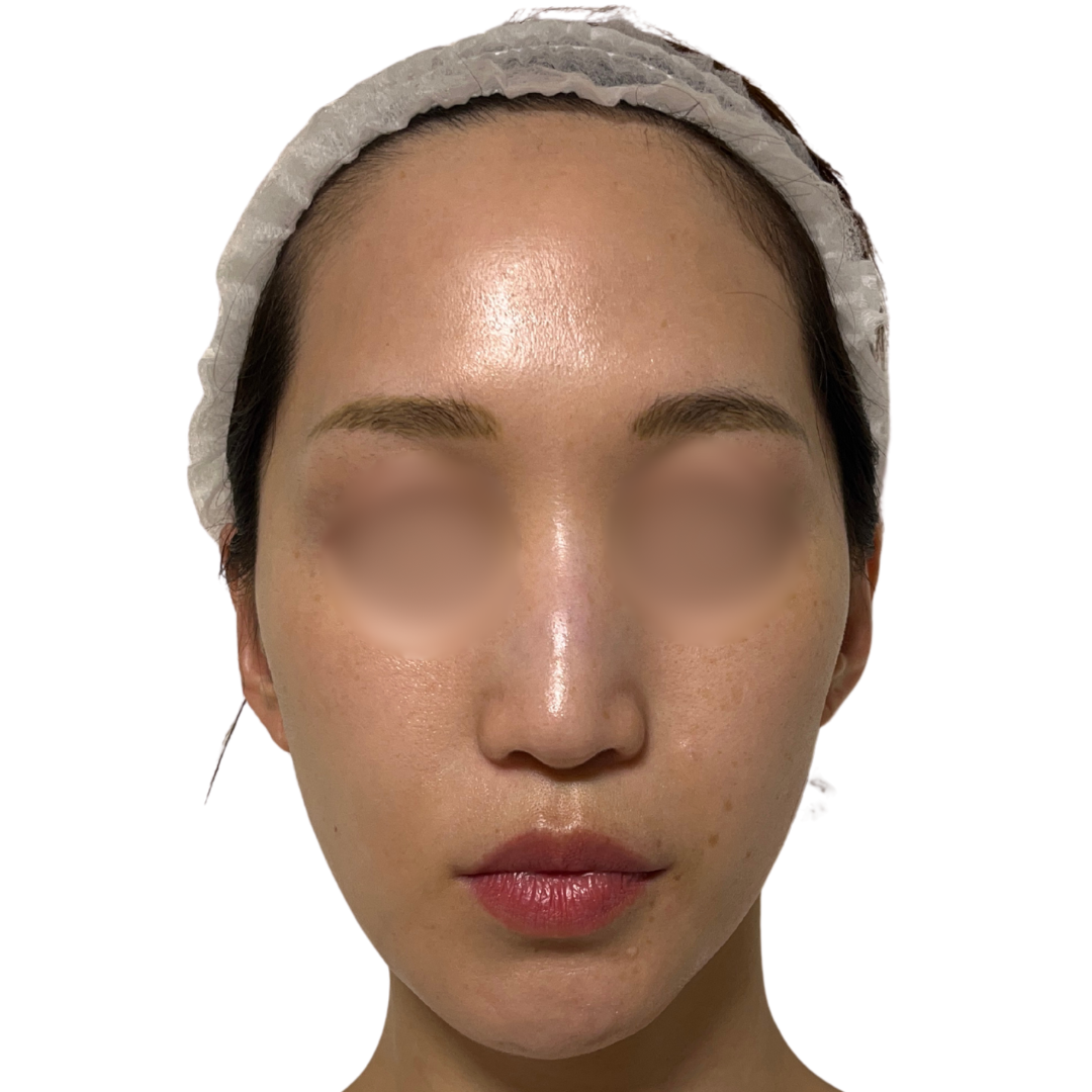 アルマ プライムX（Alma PrimeX）