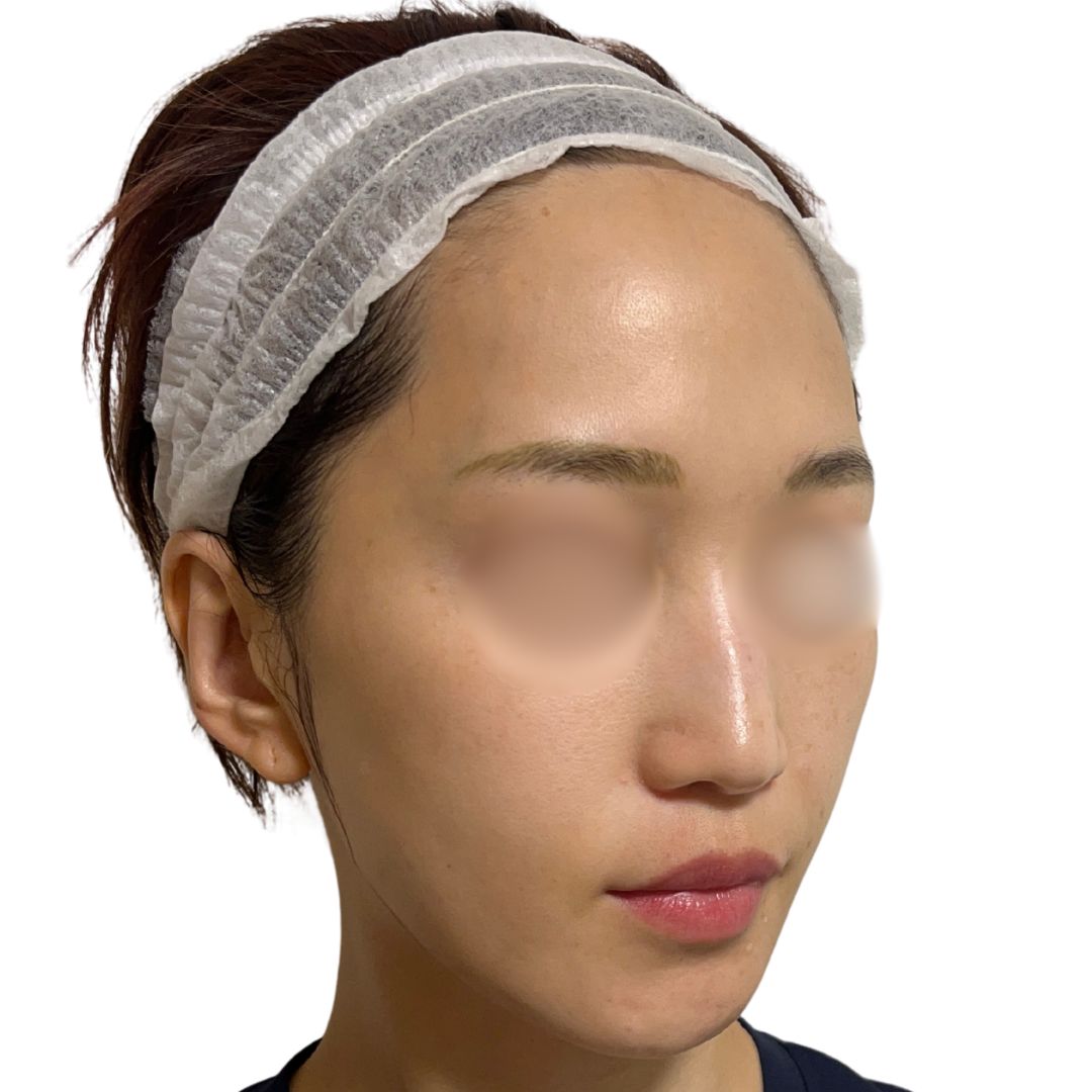 アドバテックスレーザー